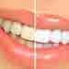 Teeth Whitening Small
