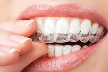 Beautiful, straight smiles with Invisalign