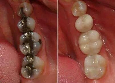 Before and after white fillings